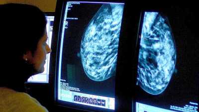 Ученые нашли способ предотвратить рак груди