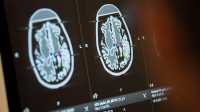 Ученые создали имплант для стимулирования мозга