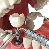 Преимущества обращения в профессиональную стоматологию
