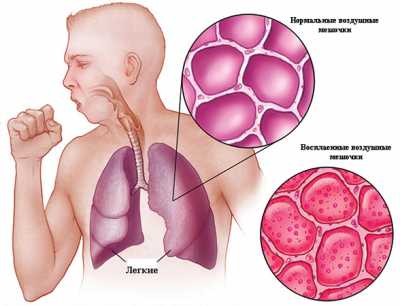 В Хакасии растет заболеваемость пневмонией