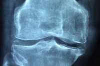 Профилактика остеопороза: советы от врачей Хакасии