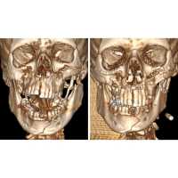 Лицевой скелет мотоциклиста восстановили абаканские врачи